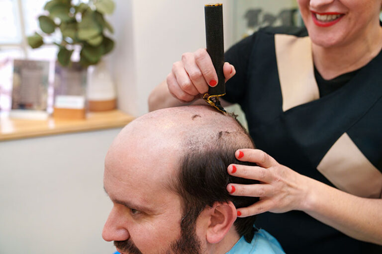 magazine_hairloss_01