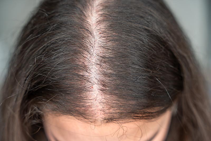 magazine_hairloss_02