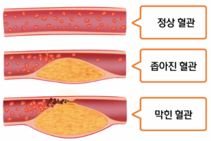 당뇨혈관